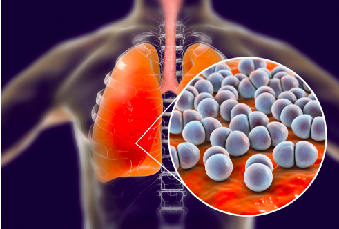 ΚΟΡΙΝΘΟΣ: “Ιδιαίτερη ανησυχία προκαλούν και οι λοιμώξεις από πνευμονιόκοκκο, οι οποίες εξακολουθούν να οδηγούν ασθενείς σε Μονάδες Εντατικής Θεραπείας…”